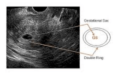 State Mandated Abortion Ultrasound